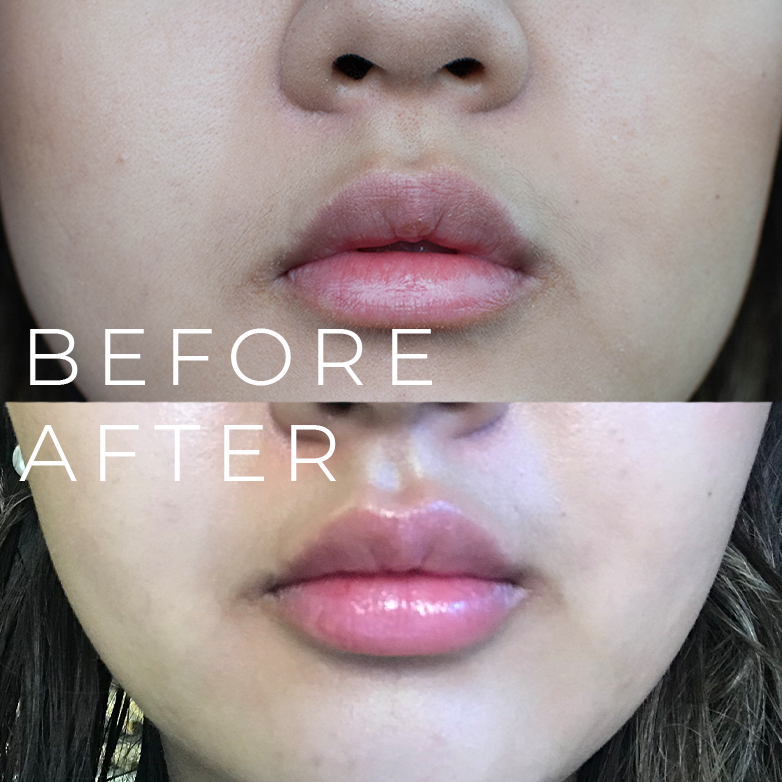 lip fillers before and after - Demi Bang